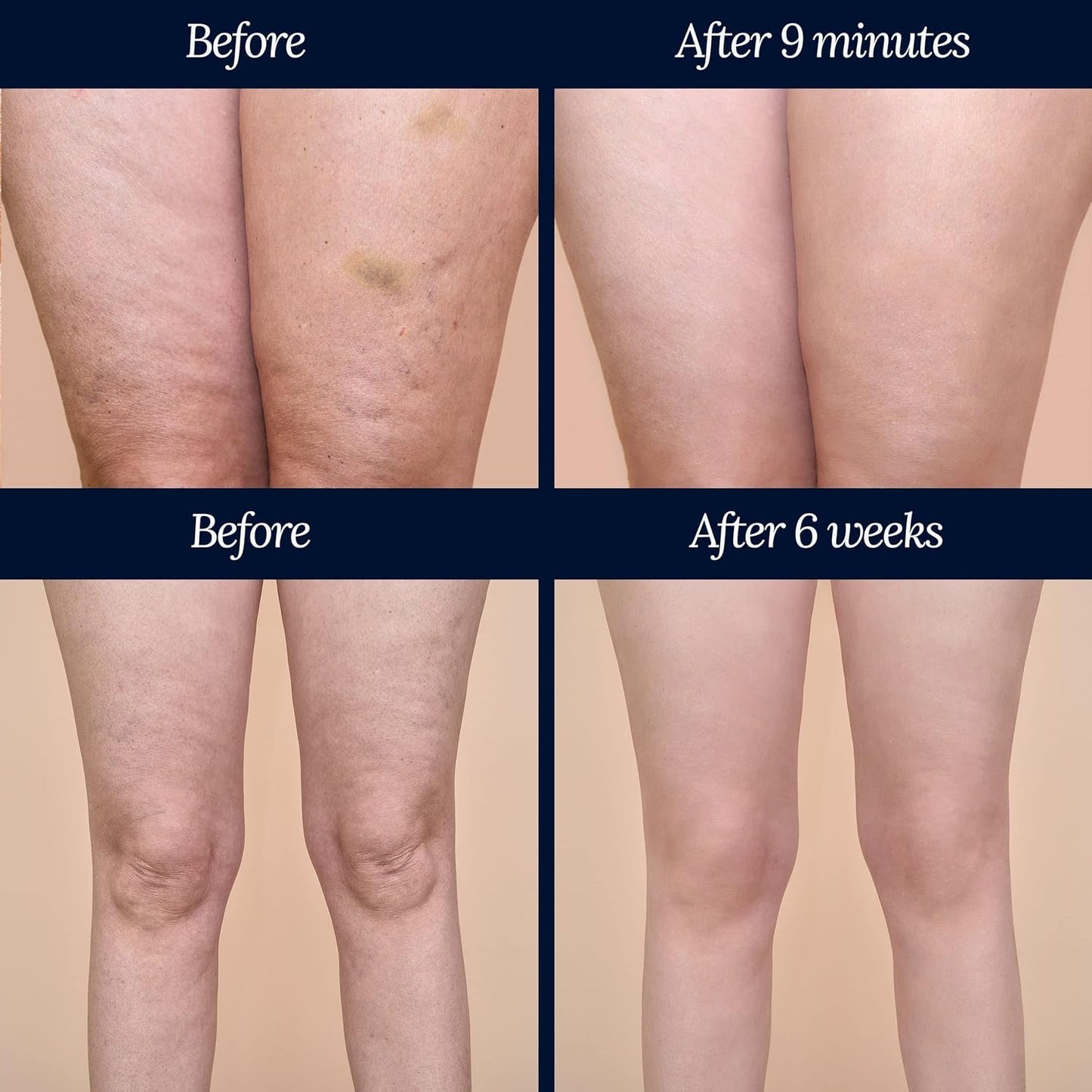 ADONIA LEGTONE – Natural cellulite cream – Organic cellulite treatment – Anti cellulite products - Soothes, relaxes, tightens, and firms the skin